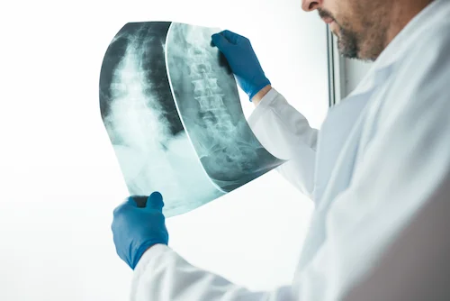 Doctor examining spinal cord injury on an x-ray